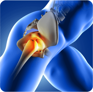 Hip Replacement Surgery